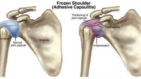 FrozenShoulder-600x338